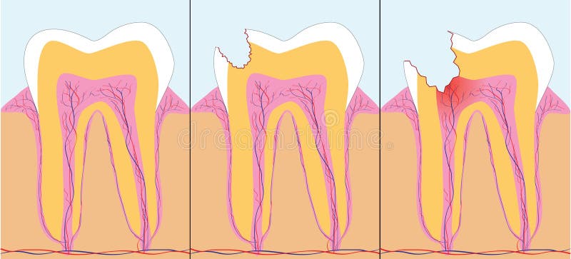 Caries. Three phase of caries, illustration additional vector illustration