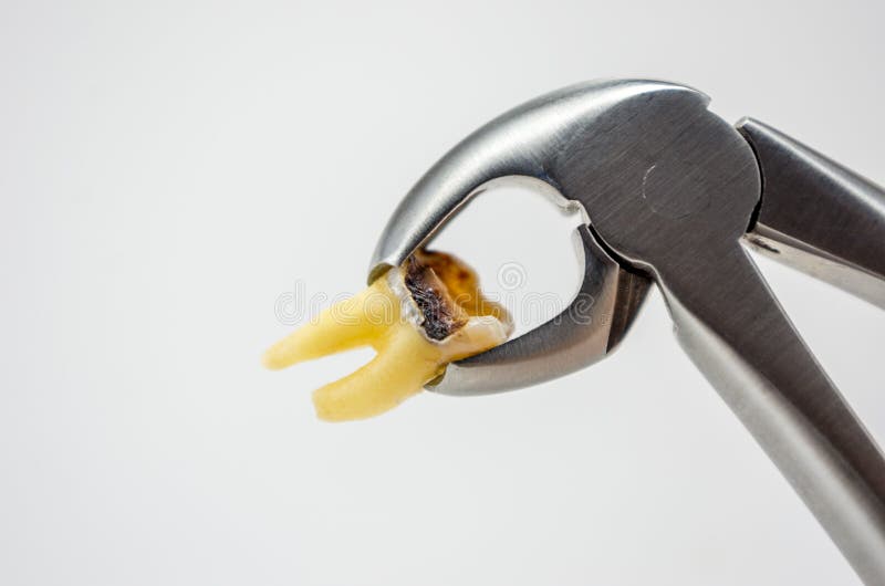 Caries-affected destroyed with a large cavity removed human tooth in surgical forceps, molar tooth, wisdom tooth, tooth extraction. Operation, dental surgery royalty free stock images