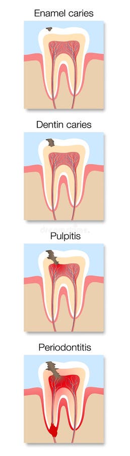 Caries Development Stages Cross Sections Tooth Decay. Caries development infographic, stages with cross section of tooth decay with enamel and dentin caries stock illustration