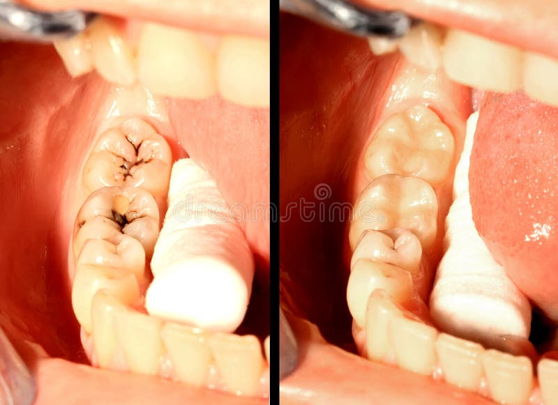Caries and restoration stock photography