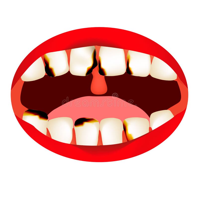 Caries. Smell from the mouth. Halitosis. The structure of the teeth and oral cavity. Diseases of the teeth caries. Infographics. Vector illustration on royalty free illustration