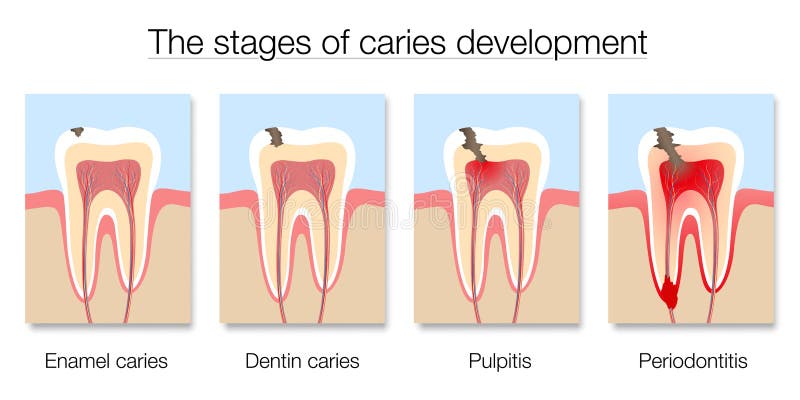 Caries Stages Development Tooth Decay Cross Sections vector illustration