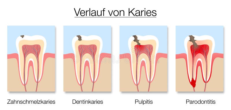 Caries Stages German Names Development Tooth Decay Cross Sections. Caries stages infographic, german labeling, development of tooth decay with enamel and dentin stock illustration