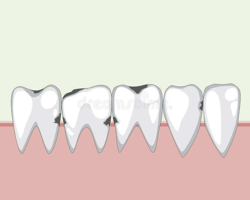 A caries on teeth with incisors and molars with gums, a vector stock illustration with adult tooth to the dental clinic as a. A molars and incisors on the gums vector illustration