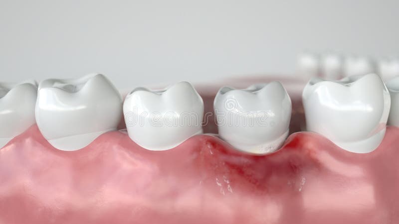 Caries in three stages - Stage 1 Gingivitis - 3D Rendering. Caries in three stages - Stage 1 Gingivitis -- 3D Rendering royalty free illustration