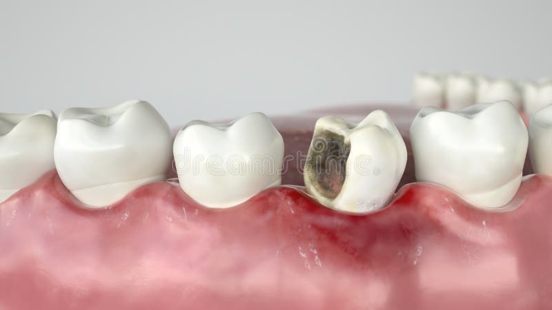 Caries in three stages - Stage 2 strong caries attack - 3D Rendering. Caries in three stages - Stage 2 strong caries attack -- 3D Rendering stock illustration