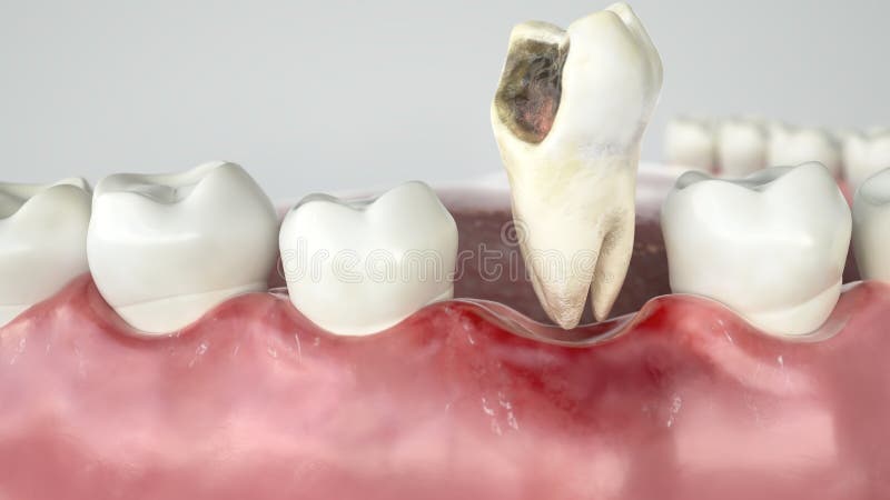 Caries in three stages - Stage 3 tooth extraction - 3D Rendering. Caries in three stages - Stage 3 tooth extraction -- 3D Rendering stock illustration