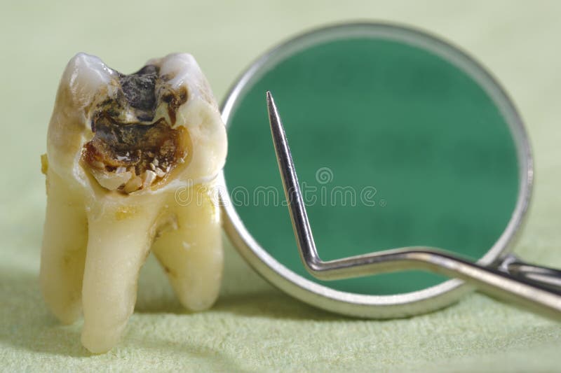 Caries on tooth stock images