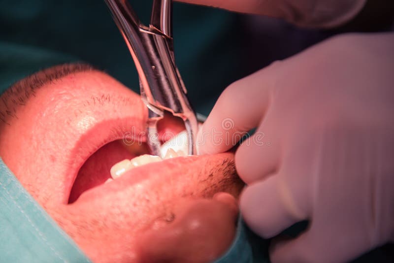 Caries tooth extraction by the dentist. Dentistry in hospital. royalty free stock image
