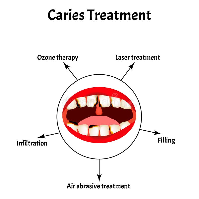 Caries treatment. Bad breath. Halitosis. The structure of the teeth and oral cavity with caries. Diseases of the teeth. Infographics. Vector illustration on royalty free illustration