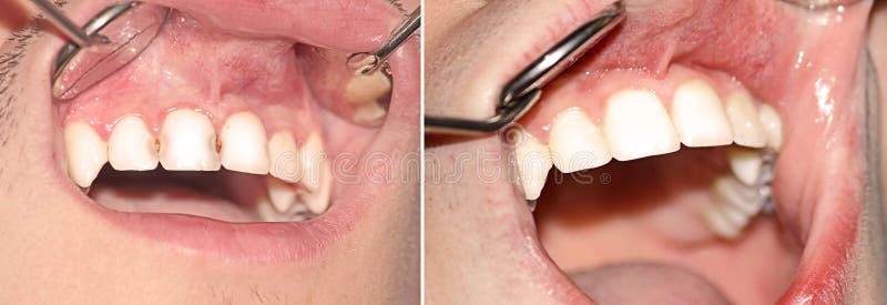 Caries before and after treatment. 
