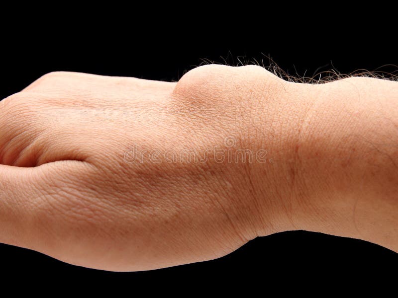 Carpal ganglion cyst. In wrist on black blackground stock image