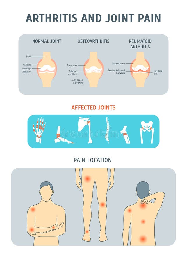 Cartoon Arthritis and Joint Pain Set. Vector royalty free illustration