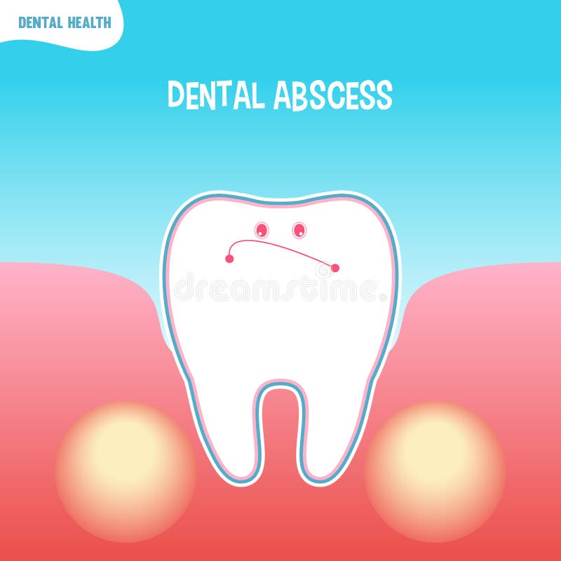 Cartoon bad tooth icon with dental abscess. Vector cartoon bad tooth icon with dental abscess vector illustration