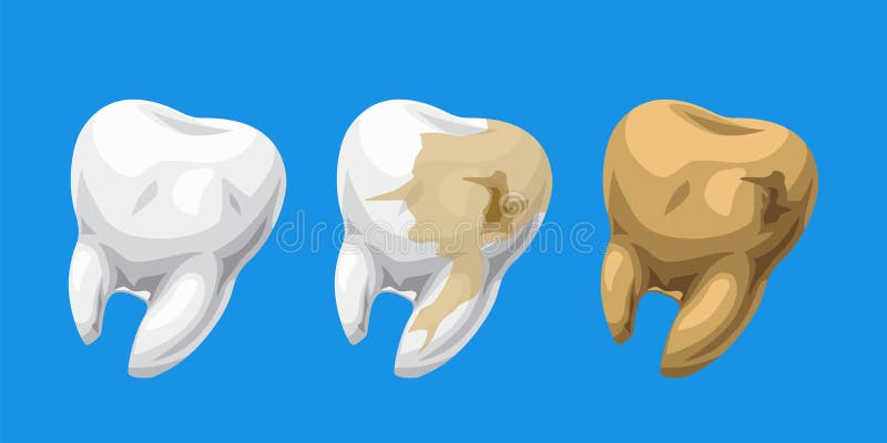 Cartoon teeth healthy and caries. Illustration of cartoon white teeth healthy and caries set on blue background stock illustration