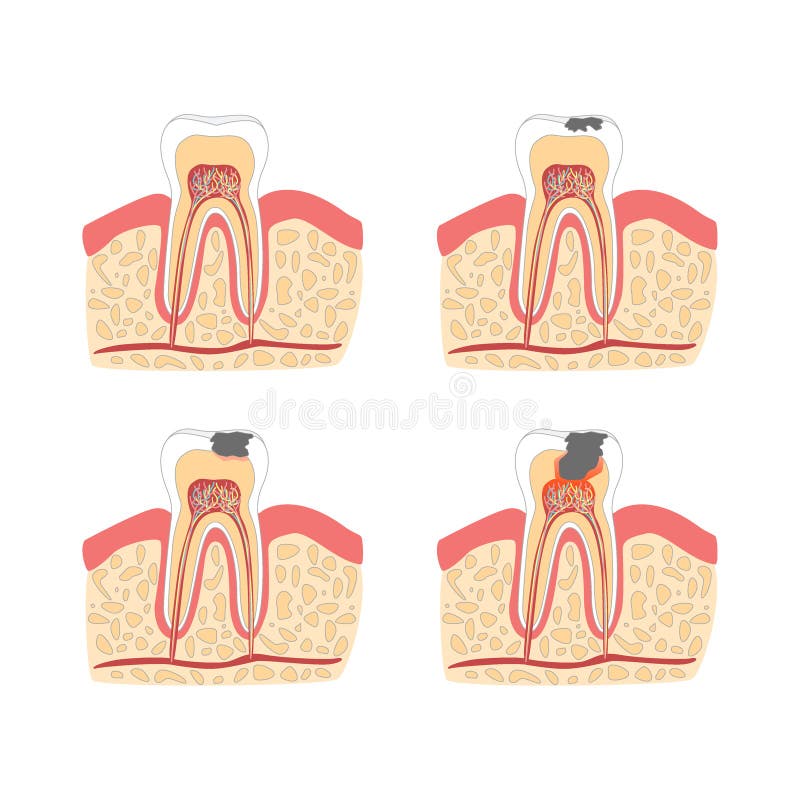 Cartoon Tooth with Stages of Dental Caries Formation Set. Vector royalty free illustration