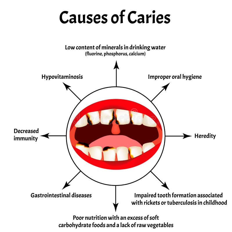 Causes of caries. Smell from the mouth. Halitosis. The structure of the teeth and oral cavity. Diseases of the teeth. Infographics. Vector illustration on royalty free illustration