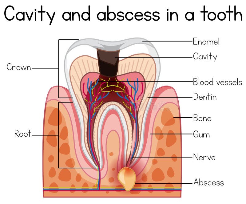 Cavity and Abscess in a Tooth. Illustration vector illustration