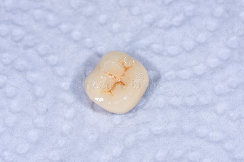 Ceramic-metal crown of a human tooth molar. Macro closeup. Dental laboratory, manufacture of tooth rub. Ceramic-metal crown of human tooth molar. Macro closeup royalty free stock photos