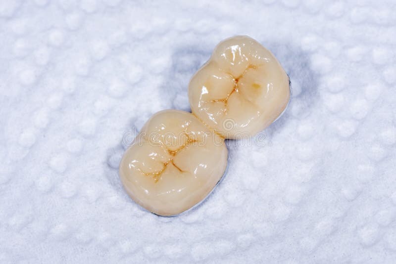Ceramic-metal crown, veneer close-up macro. Human tooth molar prosthesis. Ceramic-metal crown, veneer close-up macro. Human a tooth molar prosthesis stock images