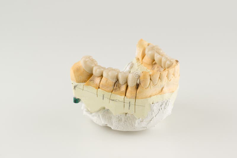 Cermet dental bridges. Artificial dental structures made of ceramics for restoration of dentition stock photos