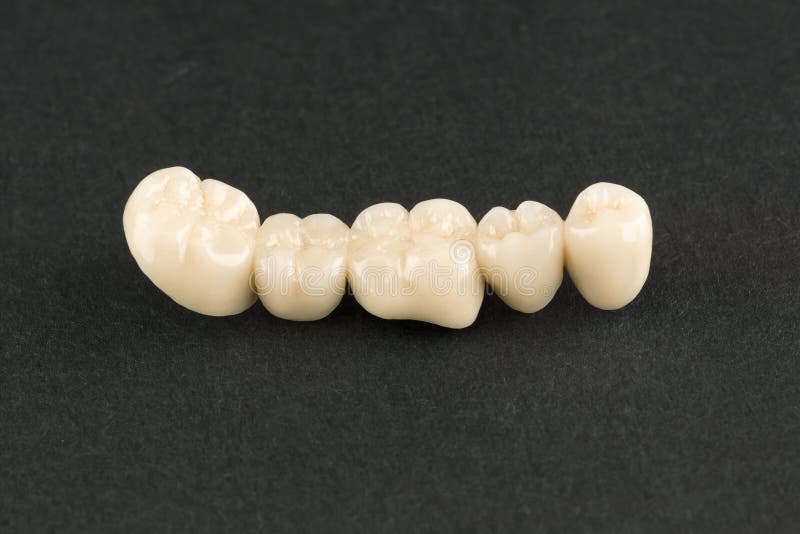 Cermet dental bridges. Artificial dental structures made of ceramics for restoration of dentition royalty free stock images