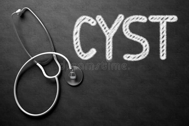 Chalkboard with Cyst. 3D Illustration. Cyst Handwritten Medical Concept on Chalkboard. Top View Composition with Black Chalkboard and White Stethoscope on it royalty free stock photo