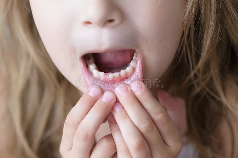 The child is growing a molar, but the milk tooth did not fall out. Problems with children`s teeth. Shark bite stock images