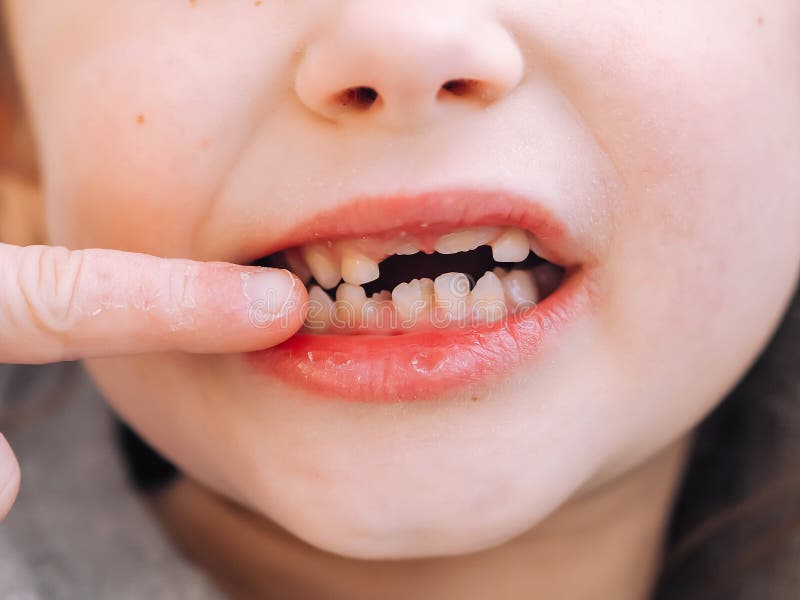 The child has a milk tooth and a new adult curve tooth. Open mouth with finger. Treatment and care milk teeth in children stock images