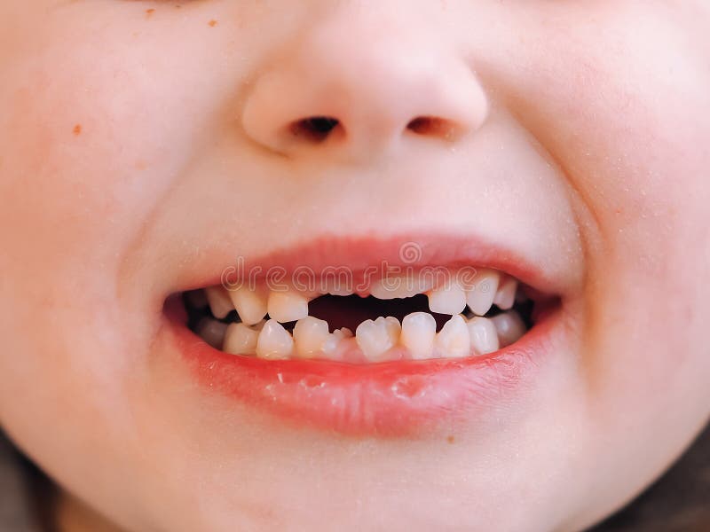 The child has a milk tooth and a new adult curve tooth. Treatment and care milk teeth in children stock photo