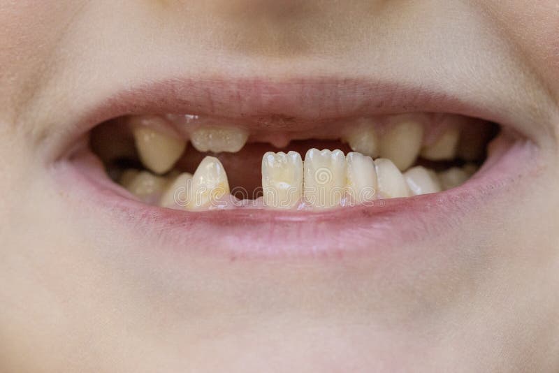 Child`s mouth close-up, tooth growth and lack thereof royalty free stock image