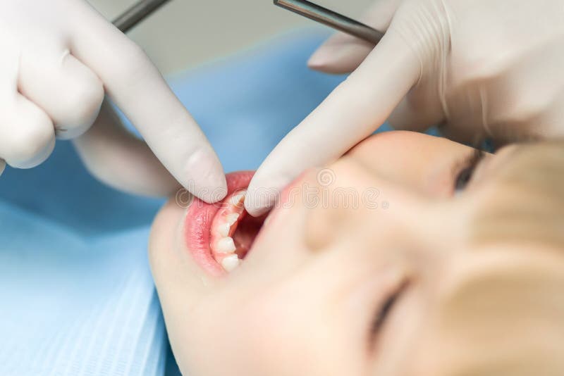 Close-up dentist hand showing milk teeth and molar. Replacemnet of baby tooth with permanent. Hole after tooth fell out. Growing o stock images