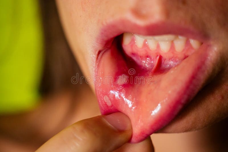 Close - up on the lip with aphthous stomatitis.  royalty free stock photos