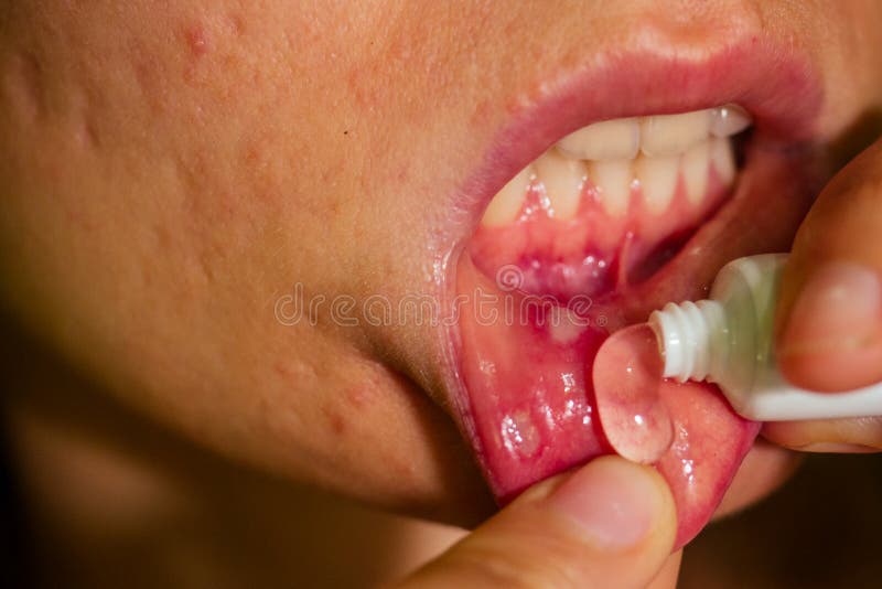 Close - up on the lip with aphthous stomatitis applying antibacterial cream.  stock images