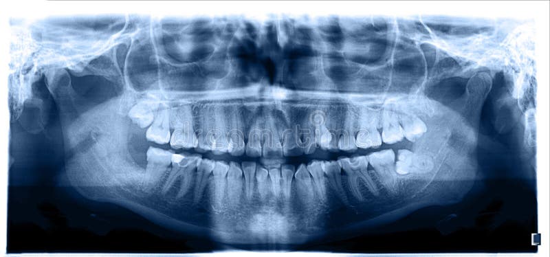 Close up. Panoramic image of the jaw, the location of the atypical / pathological wisdom tooth third molar. Blue tone image. Close up. Panoramic image of the jaw stock photography