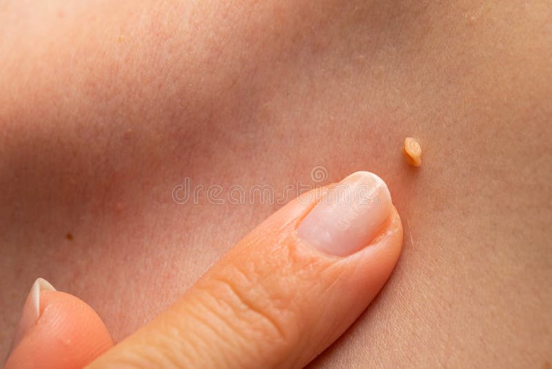 Papilloma on human skin. Close up picture of papilloma on human skin, finger pointing at the wart royalty free stock images
