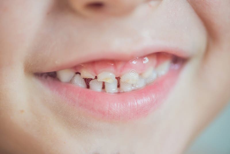 Close up shot of baby teeth with caries royalty free stock photo