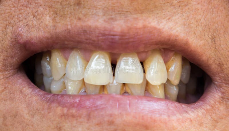 Closeup old woman teeth problems with gums or tartar for healthy royalty free stock photography