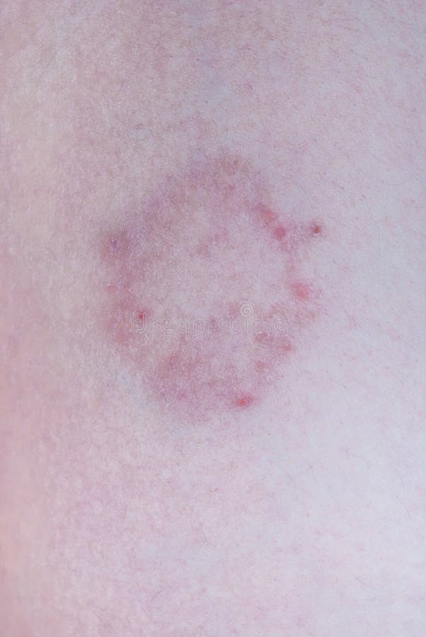 Closeup to First Step of Dermatophytosis/ Ringworm Symptom on Skin stock image