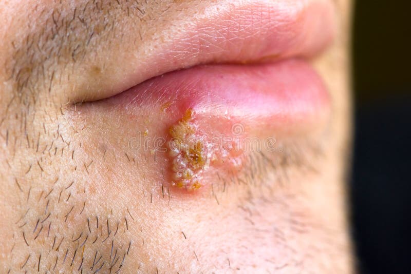 Cold sores (herpes labialis) stock photography