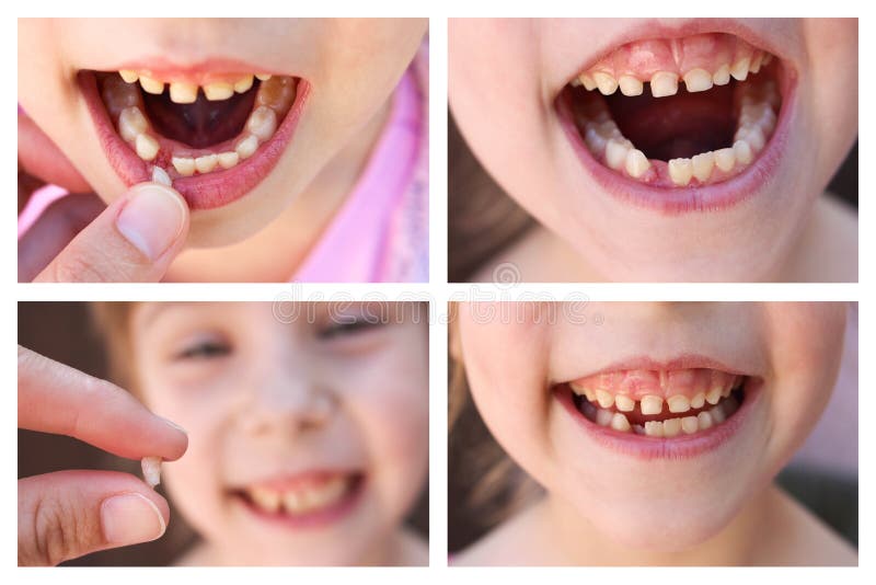 A collage of the child has lost the baby tooth. At 6 years old child loose tooth. The girl is holding the tooth in his hand. New molar tooth growing royalty free stock photos