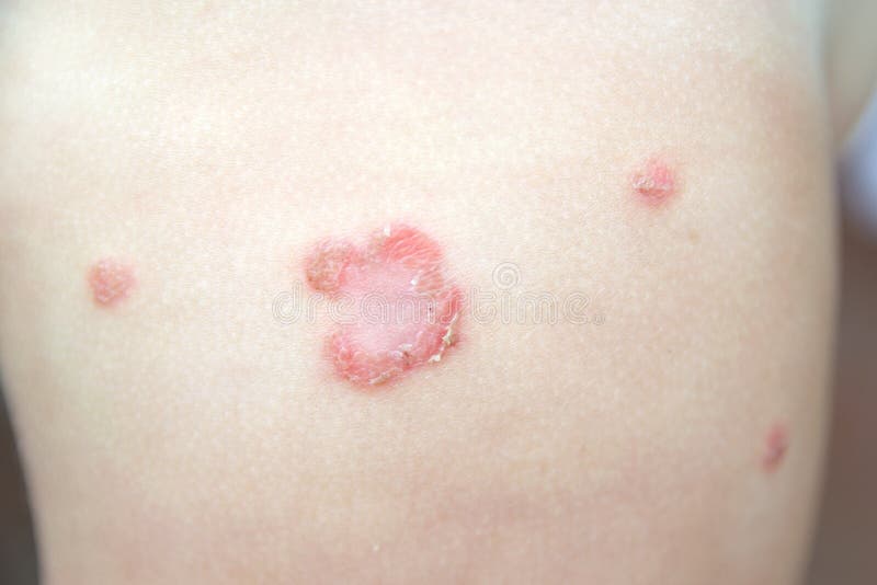 Contagious bacterial dermatologic infection impetigo on a child skin without pharmacologic treatment.  Macro shot royalty free stock image