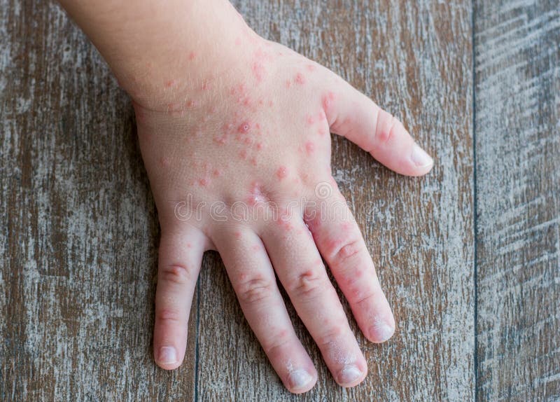 Coxsackie virus. Child with a skin rash. stock images