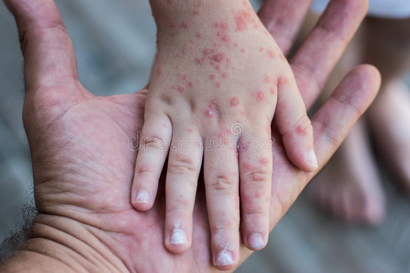 Coxsackie virus. Child with a skin rash. Coxsackie virus. Symptom of hand, ears, foot and mouth. Painful rash red spots blisters on the hand stock photo