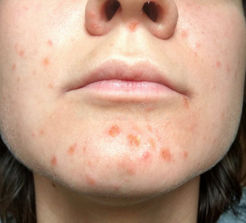 Coxsackie virus rash face. Coxsackievirus symptom of hand, foot and mouth disease painful rash blisters in the mouth stock images