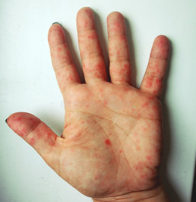 Coxsackie virus. Coxsackievirus symptom of hand, foot and mouth disease painful rash red spots blisters on the hand royalty free stock photos