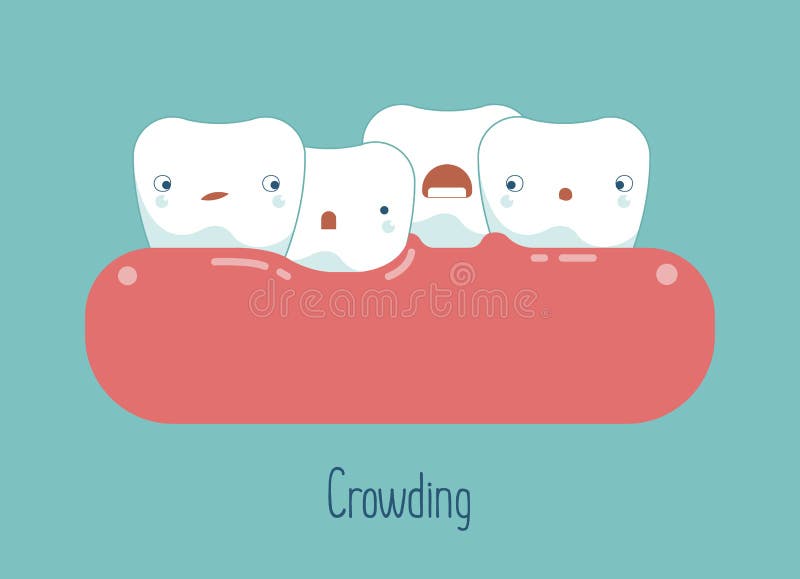 Crowding teeth ,dental concept stock illustration