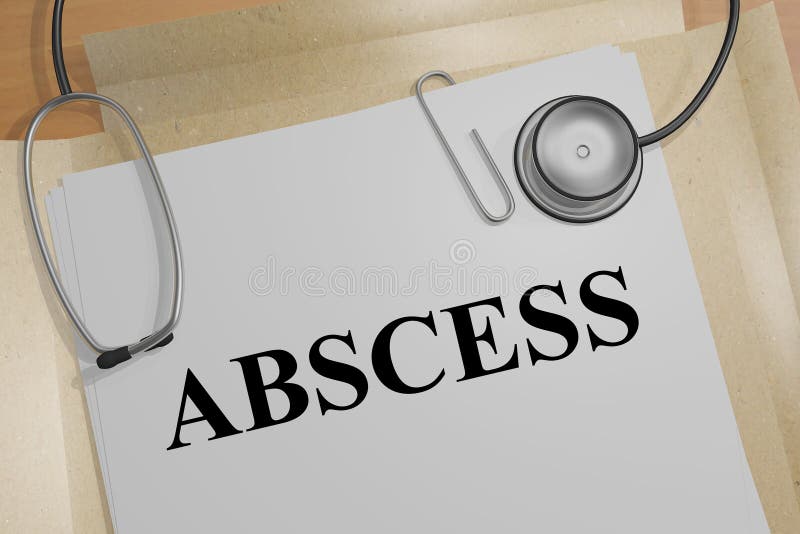 ABSCESS - medical concept. 3D illustration of ABSCESS title on a medical document vector illustration