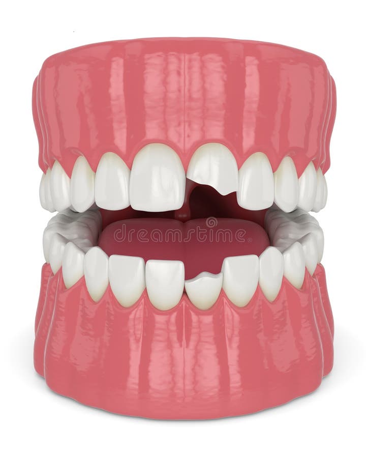 3d render of jaw with broken incisors teeth. Over white background stock illustration