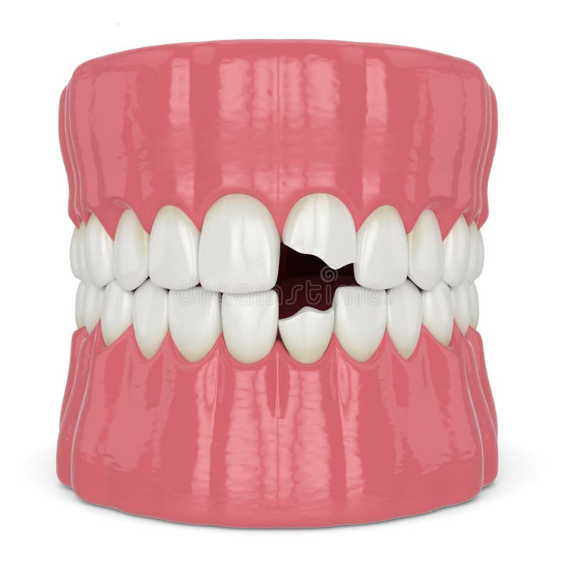3d render of jaw with broken incisors teeth. Over white background royalty free illustration